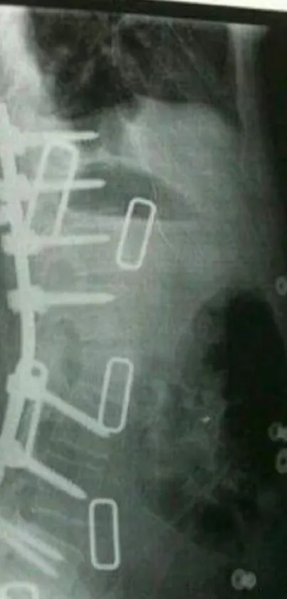 X-ray of spinal column with medical focus.